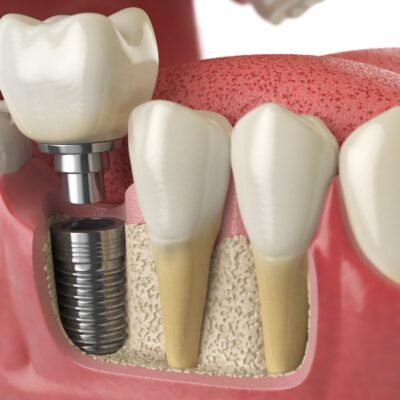 Anatomy of healthy teeth and tooth dental implant in human dentu